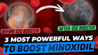 Minoxidil Boosters  3 Most Powerful Ways to Make Minoxidil MORE Powerful [upl. by Aham]