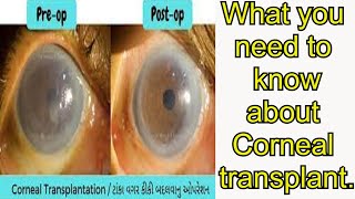 Corneal transplant Corneal scarringCorneal ulcers or infections [upl. by Akimyt]