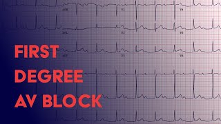 First Degree AV Block  EKG ECG Interpretation [upl. by Attenyt]