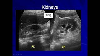 Transitional Cell Carcinoma Urothelial Carcinoma of the Urinary Bladder [upl. by Arriek]