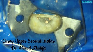 Upper Second Molar  Treatment Overview [upl. by Neel]