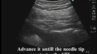 Ultrasoundguided pudendal nerve block [upl. by Autumn]