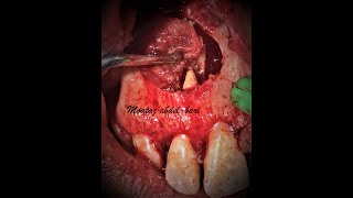 enucleation of maxillary radicular cyst with PRF placement [upl. by Celestyna471]