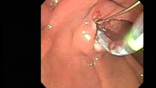 ERCP sphincterotomy stone extraction [upl. by Llenrac]