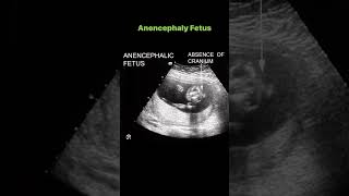 Anencephaly Fetus [upl. by Alaikim884]