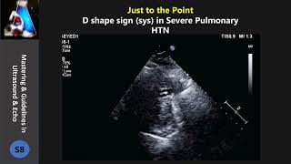 D shape sign in pulmonary hypertension [upl. by Hayashi]