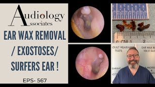 EXOSTOSESSURFERS EAREAR WAX REMOVAL  EP567 [upl. by Fulbert]