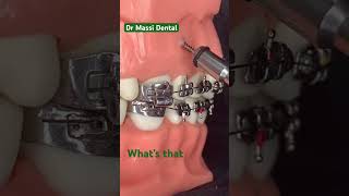 Dental Braces Orthodonticsteeth alignment [upl. by Laertnom]