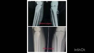 BONETUMOR REMOVALOSTEOCHONDROMAJABISETTYHOSPITALADVANCEDCENTERFOR KNEREPLACEMENTARTHROSCOPYkhmm [upl. by Lubeck]