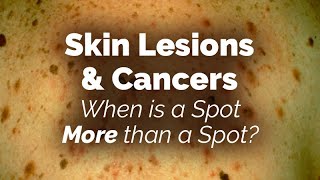 When is a Spot More than a Spot Skin Lesions and Cancers [upl. by Ahsetan]