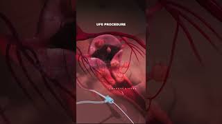 What is Uterine Fibroid Embolization procedure Types of Fibroids fibroid pregnancy animation [upl. by Portingale]