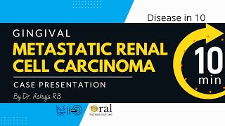 Metastatic Renal cell carcinomaOralpathology360 [upl. by Mahalia]