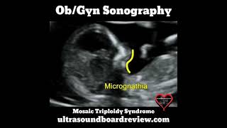 Mosaic Triploidy Syndrome [upl. by Elsi]