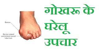 गोखरू के घरेलू उपचार  Bunion home remedies  TREATMENT OF EMBARRASSING BUNIONS  gharelu upay [upl. by Krusche]