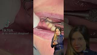 Abscesso na boca 😮 dentista odontologia abcesso [upl. by Brenner]