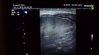 Infant hepatic hemangioma Ultrasound [upl. by Melda]