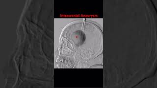 Intracranial Aneurysm radiology brain neurology [upl. by Menedez]