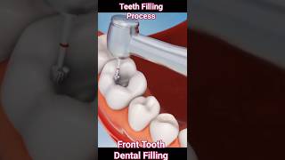 Tooth Filling Procedure Animation Teeth Filling Process [upl. by Faxan]