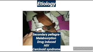 Pellagra I Niacin or Vitamin B3 deficiency I Spot diagnosis24 I Pediatrics [upl. by Chandra918]