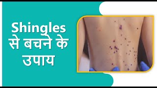 How to Prevent Shingles  Best Tips to Reduce Your Risk [upl. by Yeldah]