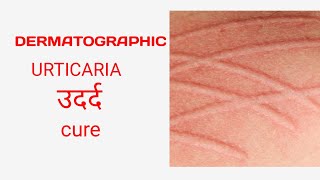 Dermatographic urticaria treatment urticaria ayurveda [upl. by Nita]