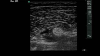 Ultrasound guided Infragluteal Sciatic Nerve Blockmov [upl. by Einobe]