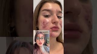 🎅SUPERHIT TREATMENT for freckles pigmentation acne spots✌️youtubeshorts shorts [upl. by Lamiv805]