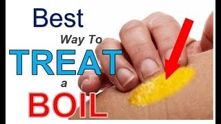 The BEST Way to TREAT a Boil 3 Simple Steps  Best REMEDY for Treating Boils FAST [upl. by Brown]