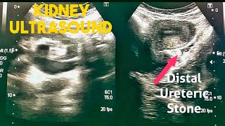 How to Renal Ultrasound  Hydronephrosis Hydroureter Distal Ureteral Stone [upl. by Safko]