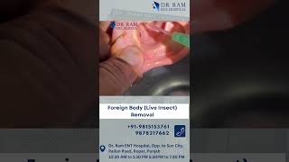 Foreign Body Removal Live insect Removal [upl. by Mehelhteb]