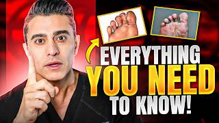 Athletes Foot 101 Everything You Need to Know [upl. by Phelps658]