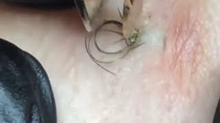 ingrown hair removal completion ingrownhair hair howto relaxing how youtube viral [upl. by Eiznekcm]