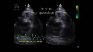 Paroxysmal supraventricular tachycardia  Tachycardie paroxystique supraventriculaire [upl. by Aitercal]