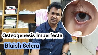 Osteogenesis Imperfecta  Bluish Sclera  Dr Abdullah Al Rafi [upl. by Ares]