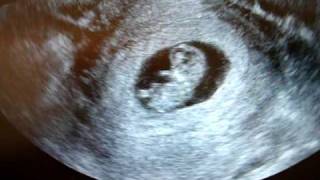 10 weeks pregnant ultrasound [upl. by Lledniw]