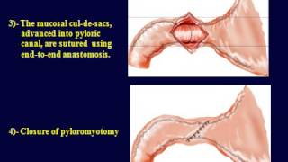 Pyloric atresia reconstruction  Dessanti technique [upl. by Kulsrud272]