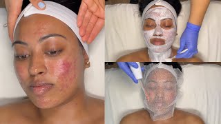 CYSTIC ACNE TREATMENT  WALKIN FACIAL FOR GRADE 3 AND 4 ACNE WITH PRO TIPS  LICENSED ESTHETICIAN [upl. by Ahsed]