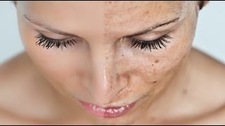 Acne Scarring VS Pigmentation  Cassandra Bankson [upl. by Cyndie]