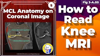 Fig 3A05 Medial Collateral Ligament Anatomy Knee MRI coronal and axial images [upl. by Horst]