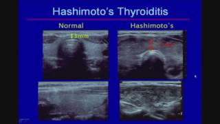 Sonographic Evaluation of Diffuse Thyroid Disease [upl. by Rehpinej]