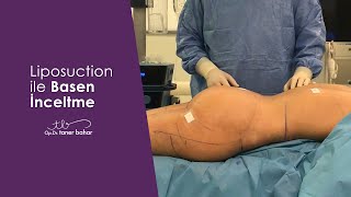 Liposuction ile Basen İnceltme  Basen ve Bacak Liposakşın  OpDrTaner Bahar [upl. by Rosetta]