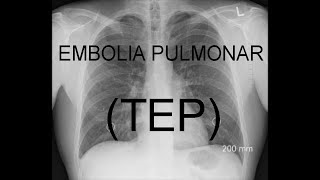 Tromboembolismo Pulmonar Semiología  Dr Alejandro Dangelo [upl. by Trabue846]