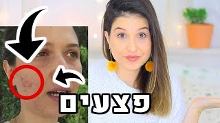 איך העלמתי את כל החצ׳קונים שלי במה אני משתמשת היום לפצעונים הכל על הפנים שלי [upl. by Eidua240]