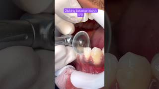 IPR BRACES Orthodontics Treatment [upl. by Nerra381]