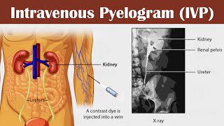 Intravenous pyelogram IVP [upl. by Cyrus498]