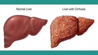 Living With Cirrhosis [upl. by Sharai621]