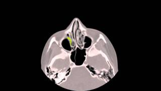 Enhanced Axial CT Scan of a right antrochoanal polyp [upl. by Cheria]