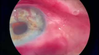 GATT is a Glaucoma MIGS procedure [upl. by Lain]