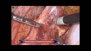 Fluorescence guided Laparoscopic Lateral Pelvic Lymphnode Disection in rectal cancer [upl. by Esilahc]