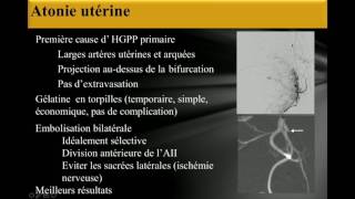 L’embolisation artérielle [upl. by Socin]